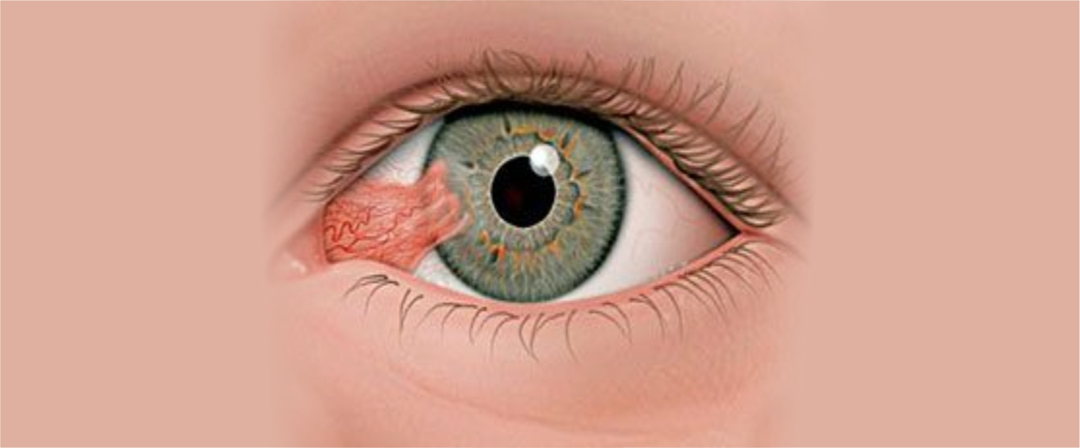 Ojos_pterigión04
