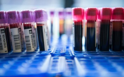 ”Liquid biopsy”: un test promete detectar varios tipos de cáncer – Alice Lanzke (dpa)